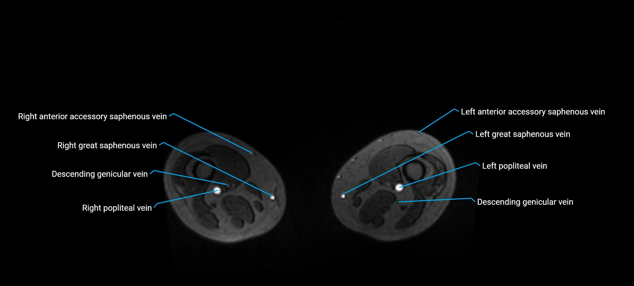MRV abdomen pelvis & lower limb axial cross sectional anatomy labelled MRI image 323.webp